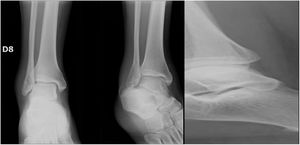 Caso Clínico 3 Imagen Proyección unilateral con Fractura Weber B.