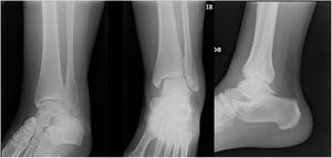 Clinical Case 2 Image. Unilateral fracture series.