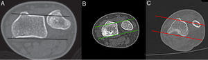 En la imagen A se observa el metodo de Mino tomado del Articulo Judy H. Squires 2014 (6), en la Imagen B se observa el Metodo de mino sin alteracion (verde) y en la imagen C observamos el metodo alterado en paciente de nuestra muestra (rojo).
