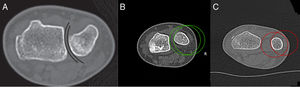 En la imagen A se observa el metodo de Congruencia tomado del Articulo Judy H. Squires 2014 (6), en la Imagen B se observa el Metodo de congruencia sin alteracion (verde) y en la imagen C observamos el metodo alterado en paciente de nuestra muestra (rojo).