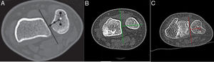 En la imagen A se observa el metodo de Epicentro tomado del Articulo Judy H. Squires 2014 (6), en la Imagen B se observa el Metodo de epicentro sin alteracion (verde) y en la imagen C observamos el metodo alterado en paciente de nuestra muestra (rojo).