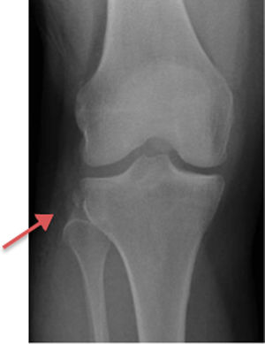 Radiografía AP de rodilla. Se evidencia fractura de Segond (flecha roja).