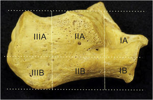 Delimitación de las 06 zonas de seguridad (IA, IB, IIA, IIB, IIIA, IIIB) del calcáneo en pieza ósea.
