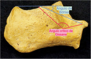 Medidas del ángulo de Böhler y ángulo crítico de Gissane en pieza ósea.