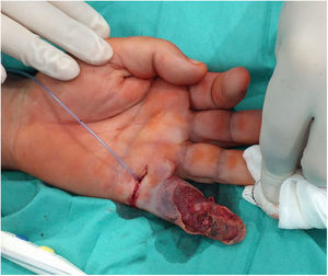 Imagen del desbridamiento quirúrgico urgente y el lavado a través de la vaina sinovial.