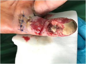 Aspecto de la herida al ser consultada a la Unidad de Mano. Herida exudativa con desvitalización de tendones flexores y defecto de cobertura.