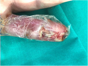 Herida cubierta con apósito plástico tras la aplicación del sevoflurano.