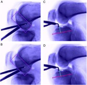 Imagen que evidencia el punto considerado como adecuado por el cirujano para el posicionamiento del túnel femoral y tibial (A y C) y el ajuste realizado bajo visión fluoroscopica para lograr el punto “blanco”. Tomado y modificado de Moloney G, Araujo P, Rabuck S, Carey R, Rincon G, Zhang X, et al. Use of a fluoroscopic overlay to assist arthroscopic anterior cruciate ligament reconstruction. Am J Sports Med. 2013;41(8):1794-800.