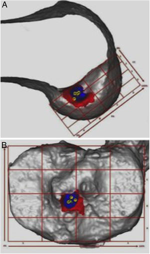 Representación tridimensional de la huella femoral (A) y tibial (B) (en rojo) con el punto ideal para el posicionamiento de los túneles (en azul) y el eje central a 0°, 45° y 90° de flexión (en amarillo). Tomado y modificado de Tampere T, Van Hoof T, Cromheecke M, Van der Bracht H, Chahla J, Verdonk P, et al. The anterior cruciate ligament: a study on its bony and soft tissue anatomy using novel 3D CT technology. Knee surgery, sports traumatology, arthroscopy: official journal of the ESSKA. 2017; 25(1):236-44.