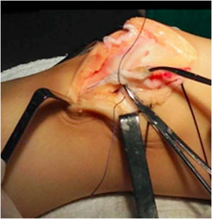 Sutura de la cápsula articular interna mediante puntos de tensión para estrechar la laxitud capsular previa. En éste momento la rótula comienza a desplazarse hacia interno por tracción de la cápsula articular suturada.