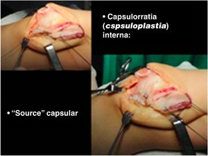 Imbricación capsular mediante una sutura en zurcido “sourcet”, lo cual permite un reforzamiento de la sutura capsular. Nótese la rótula perfectamente centrada.