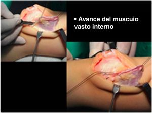 El músculo vasto interno oblicuo, previamente reparado, se avanza hacia distal, abajo y afuera sobre la rótula.