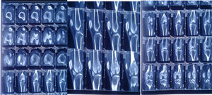 Tac de rodilla cortesía de HPDA cortes coronales y sagitales donde se evidencia fractura unicondilar posterior de cóndilo lateral (fractura hoffa) con tercer fragmento.