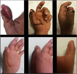 De izquierda a derecha la fila superior: Lesión distal volar de pulgar izquierdo, resultado dos semanas post operatorio de Colgajo Volar Homodigital tipo Elliot. En la fila inferior: resultado a 12 semanas post operatorio.