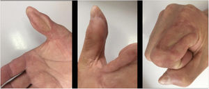 Resultado post operatorio de Colgajo Dorsal Heterodigital tipo Cross Finger. De izquierda a derecha se aprecia pulgar con sitio receptor e índice con defecto cutáneo estético de sitio dador.