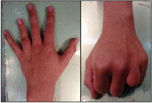 4° dedo de la mano izquierda más corto y limitación funcional para el cierre del puño.