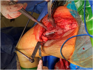Ventana femoral para el retiro de la parte lisa del vástago femoral.