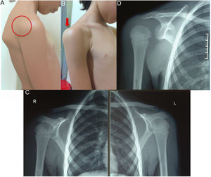 Correlación clínico-radiológica. A y B: luxación voluntaria del hombro derecho donde se hace evidente la posición de la cabeza humeral en sentido posterior. C: Radiografías AP de hombros normales. D: proyección AP justo en el momento de la luxación.