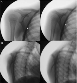 Fluoroscopia dinámica. A: Luxación de hombro derecho y su reducción en el plano AP. B: Luxación posterior de hombro derecho y su reducción en el plano lateral.