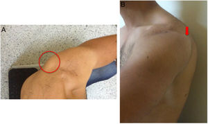 A y B: luxación voluntaria del hombro izquierdo en donde se hace evidente la cabeza humeral en sentido posterior.
