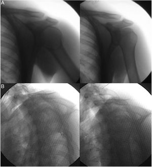 Fluoroscopia dinámica. A: luxación de hombro izquierdo y su reducción en el plano AP. B: luxación posterior de hombro izquierdo y su reducción en el plano lateral.