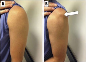 Paciente con inestabilidad multidireccional del hombro izquierdo. A: en reposo. B: luxación voluntaria anterior e inferior. La flecha señala la prominencia del acromion. Matthew D. Milewski, MD, Carl W. Nissen, MD. Pediatric and Adolescent Shoulder Instability. Clin Sports Med. 2013 Oct;32(4):761-79.