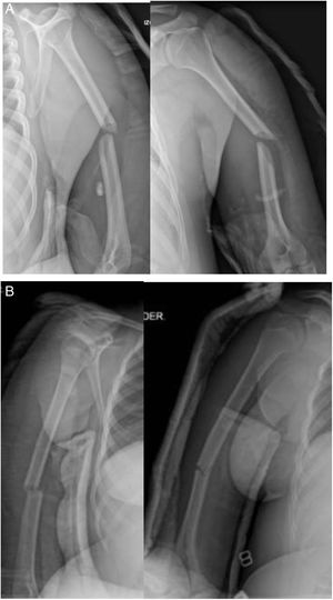 Radiografías de control cuando ya se ha desarrollado la neuroapraxia del nervio radial en ambos pacientes. (A) Imágenes del paciente masculino realizadas cinco días después del trauma. (B) Imágenes de la paciente femenina tomadas nueve días luego del trauma.