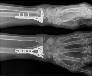 Radiografía primer paciente.