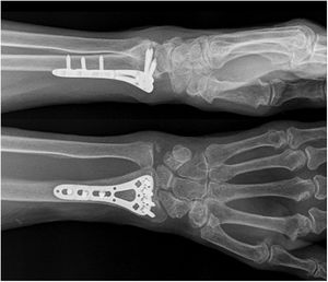 Radiografiía cuarta paciente.