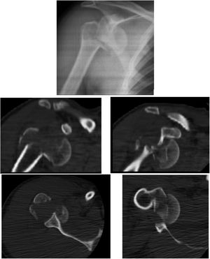 Rayos X y TAC inicial de urgencias.