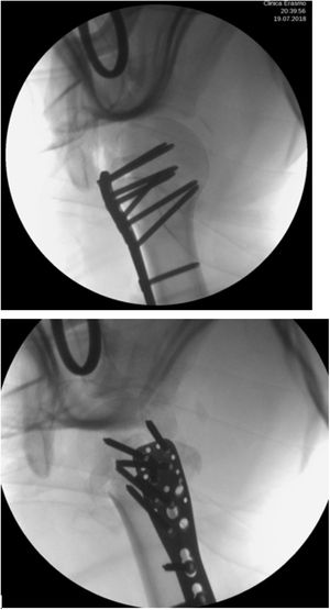 Valoración con intensificador de imagen de la fijación.