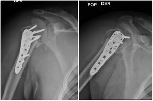 Rayos X del post quirúrgico inmediato.