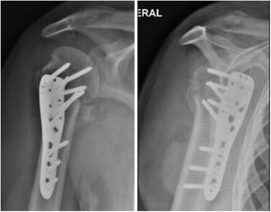 Rayos X de control a los 3 meses.