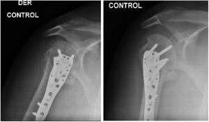 Rayos X de control a los 6 meses.