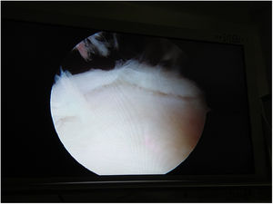 Daño de cartílago articular en la patela. Visión artroscópica.