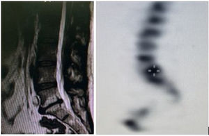 (A) Paciente de 34 años sin comorbilidades con severo dolor lumbar de predominio en sedestación, no toleraba ni 5 minutos sentado, además el Valsalva y los impactos axiales empeoraban su dolor. A la resonancia encontramos cambios tipo MODIC 1 del disco L5 S1 los cuales son sensibles y específicos para dolor discógeno en el contexto del paciente (B) SPECT que muestra captación en.
