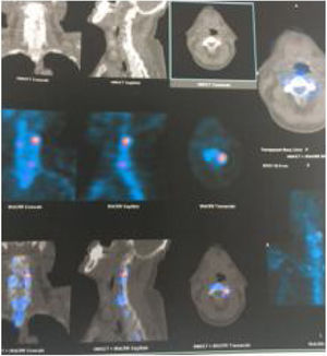 Gammagrafía con imágenes de fusión de SPECT/CT en la cual confirmamos una enfermedad facetaria C2 C3 izquierda. El paciente llevaba 6 meses de síntomas importantes sin mejoría en el manejo conservador. El dolor y la limitación cedieron luego de una inyección de esteroides y anestésicos guiada por fluoroscopia en esa articulación en particular.