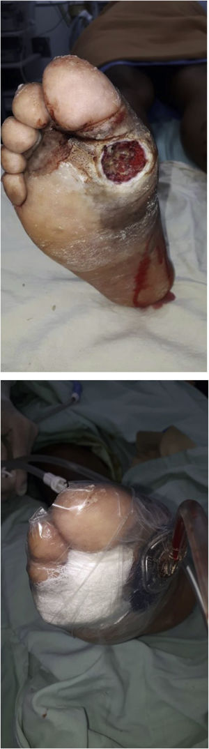 Manejo de úlceras con terapia de presión negativa.