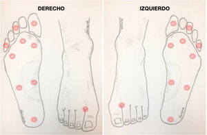 Sitios de examen del pie diabético con monofilamentos de Semmes Wenstein 5.07 (10-gr.) con la codificación de cada sitio. Reproducido con autorización de Herrera-Arbelaez JM disponible en: ht**tps://w**ww.drherreradelpie.com/protopacientes/piediabetico.pdf.