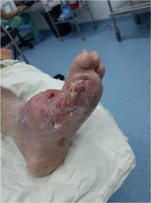 Manejo con desbridamiento en pie de Charcot.