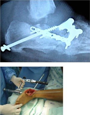 Manejo quirúrgico de artropatía de Charcot.