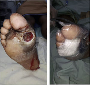 Management of ulcers with negative pressure therapy.