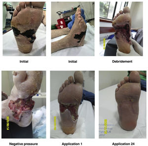 Management of ulcers with debridement and negative pressure therapy.
