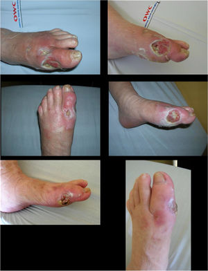 a and b: diabetic ulcer surgically debrided with medial and dorsolateral joint exposure of the left hallux MP; c and d: progression of the ulcer after 4 weeks of weekly application of PRP with antibiotic dilution and selection of the antibiotic according to the antibiogram; e and f: progression of the ulcer after 8 weeks of local application of PRP with antibiotic dilution and selection of the antibiotic according to the antibiogram.