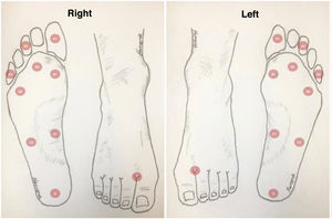 Diabetic foot examination sites with Semmes Weinstein 5.07 (10-gr.) monofilaments and coding of each site. Reproduced with permission from Herrera-Arbelaez JM, available at: ht**tps://w*w*w.drherreradelpie.com/protopacientes/piediabetico.pdf.
