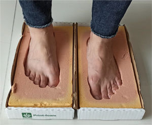 Foot printing in medical grade foam mould to create a full-contact brace.