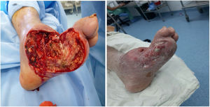 Management with debridement in Charcot foot.