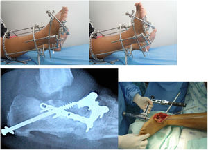 Surgical management of Charcot arthropathy.
