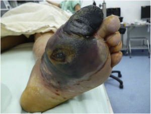 Management of ulcers.