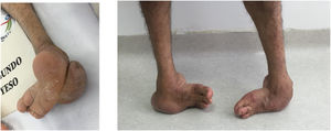 paciente de 66 años con PEVC bilateral sin tratamiento con higroma dorsal por apoyo patológico.